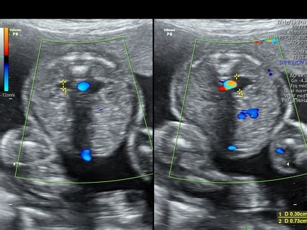 echogenic intracardiac focus radiopaedia.